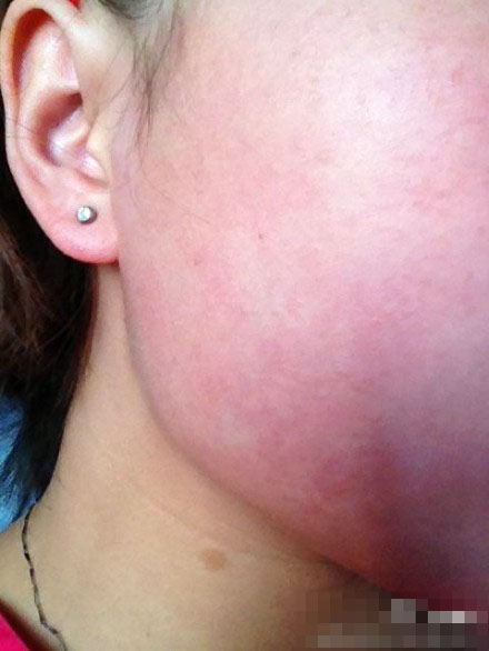 消費者用玫琳凱滿臉紅疙瘩 連打三天吊瓶險毀容