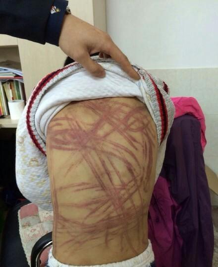 涉嫌故意對9歲男童施某某施暴的養(yǎng)母李某某已被依法刑事拘留。