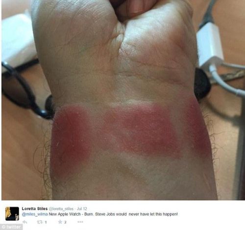 蘋果手表灼傷女子手腕 被告知“肯定戴錯了”