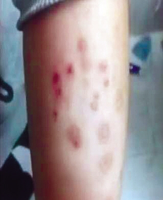 常州外國語學校，部分在校學生手部、臉部等出現(xiàn)大面積紅疹。 視頻截圖