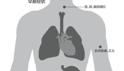 廣東全省登革熱病例增至20132例 死亡5例