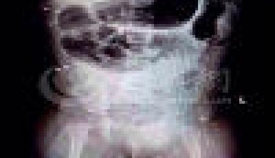 11個月大女嬰體內被插16根鋼針 警方已立案