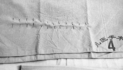 被針扎女嬰體內(nèi)12根鋼針曝光 醫(yī)生用手頂出3根