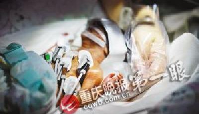 中國最小早產嬰：體重1.3斤 僅1根筷子長(圖)