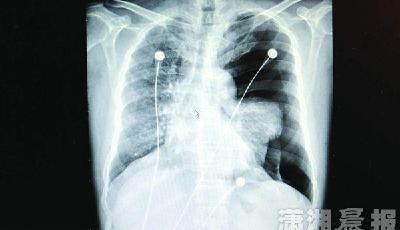 太拼啦！“麥霸”K歌飆高音 引氣胸差點要命