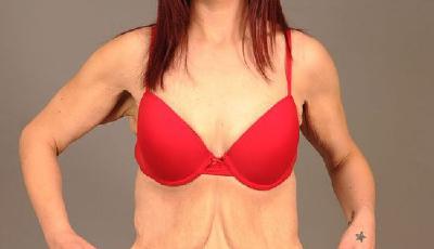 英女子為婚禮狂減114斤致皮膚松垮如老婦