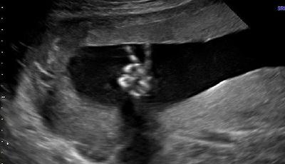 英國一胎兒在媽媽腹中用小手比出“剪刀手”