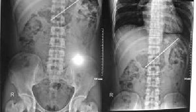 小伙戀情遭父母反對(duì) 吞下燒烤釬子1個(gè)月才就醫(yī)