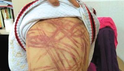 南京“虐童”養母李某某涉嫌故意傷害被刑事拘留