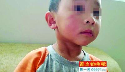 3歲男童不吃青菜被老師用筷子打 多處組織挫傷