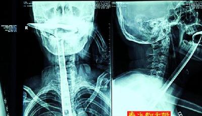 女子喉嚨難受將鍋鏟插進食道 4歲女兒救了媽媽