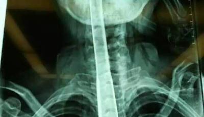 女子因喉嚨難受 把30公分炒菜鍋鏟插進食道