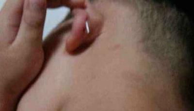 福建4歲幼童耳朵被幼兒園教師用釘釘穿