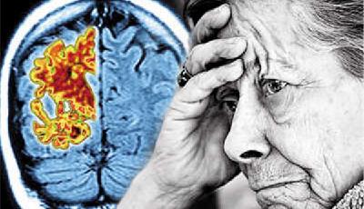 外媒：女性更易患阿爾茨海默癥 風險是男性兩倍