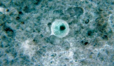 14歲少年游泳感染"食腦蟲" 被折磨一周死亡