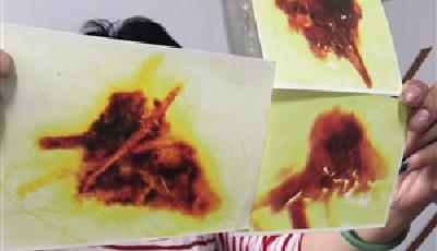 寄生蟲在女子身上安窩 四年前用過病逝老人被子