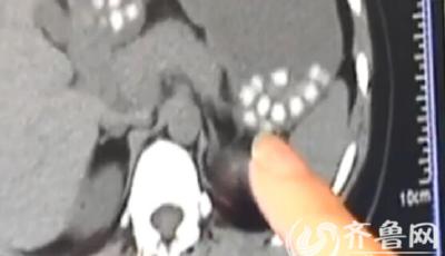 記者親自喝珍珠奶茶拍CT 胃里"珍珠"清晰如石子