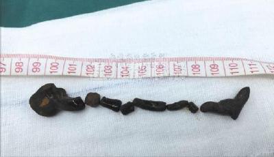 10厘米蛔蟲鉆入老人膽管 整條蟲變成石頭(圖)