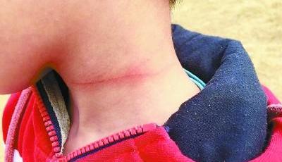 男孩踏青脖子被風(fēng)箏線勒破 專家：韌性好易傷人