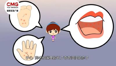 傳染性極強(qiáng)！手足口病來襲，家有孩童請(qǐng)注意